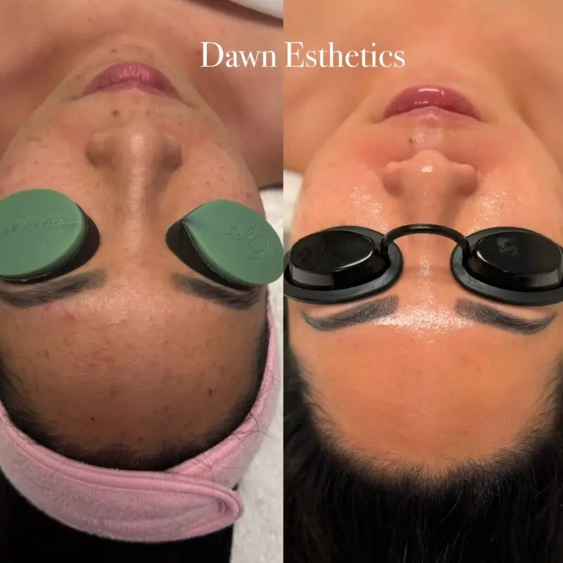 Skin progress during a course of acne treatments at Dawn Esthetics