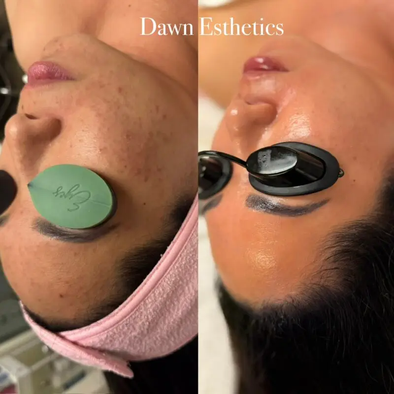 Skin progress during a course of acne treatments at Dawn Esthetics