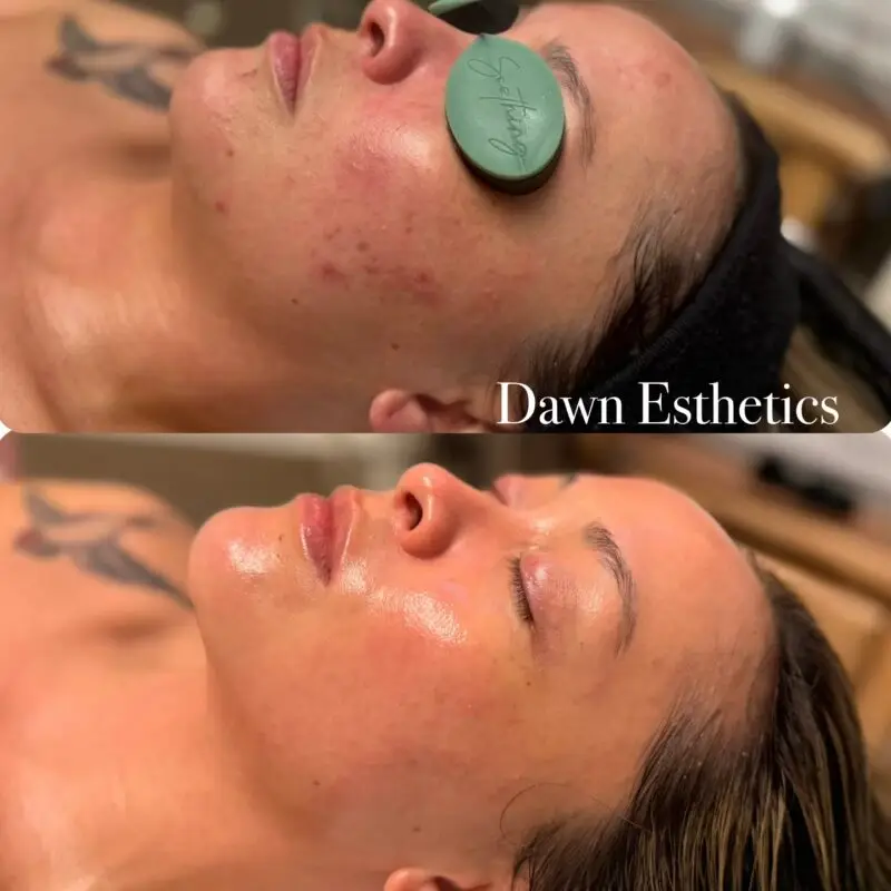 Skin progress during a course of acne treatments at Dawn Esthetics
