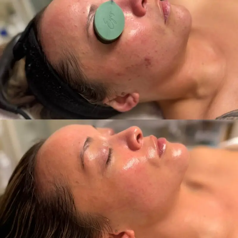 Skin progress during a course of acne treatments at Dawn Esthetics