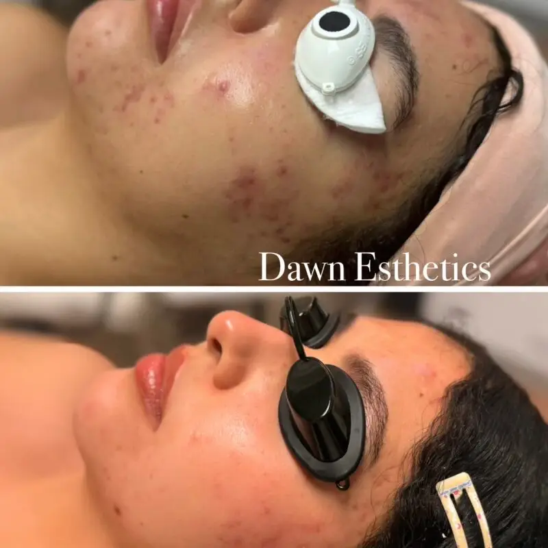 Skin progress during a course of acne treatments at Dawn Esthetics