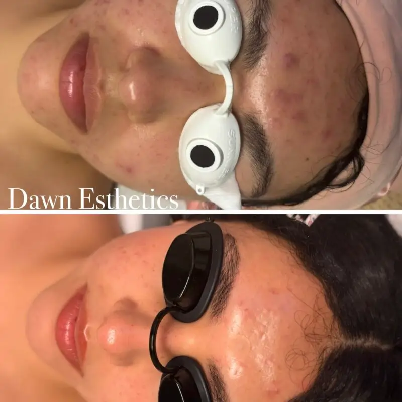 Skin progress during a course of acne treatments at Dawn Esthetics