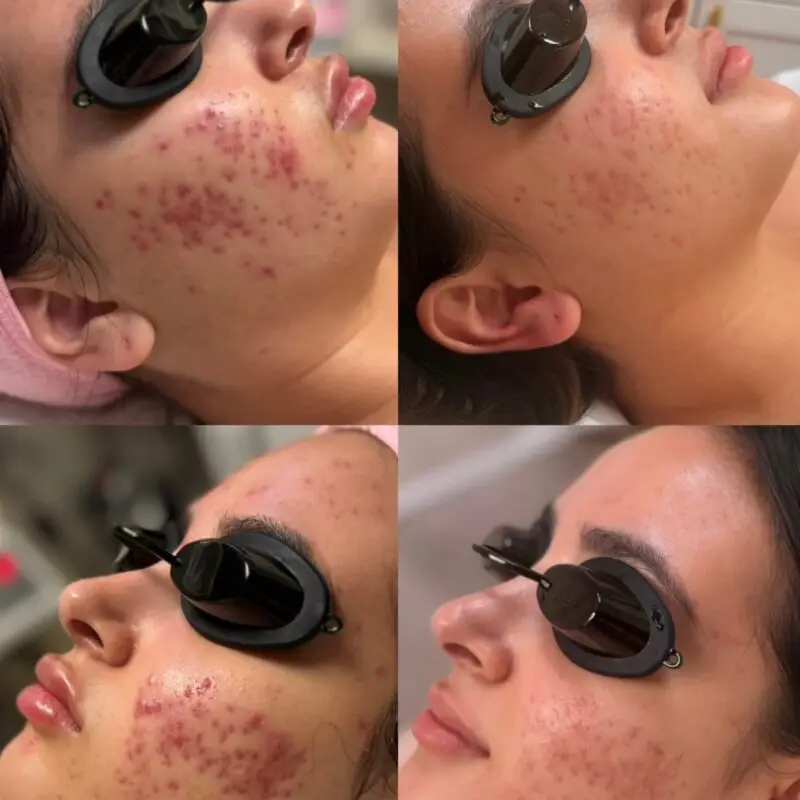 Skin progress during a course of acne treatments at Dawn Esthetics