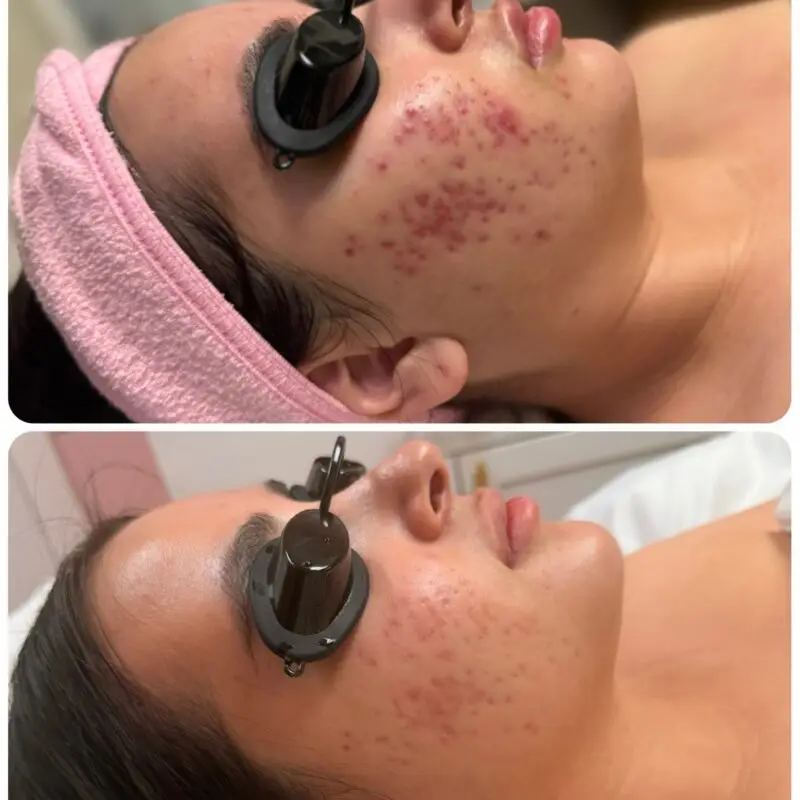Skin progress during a course of acne treatments at Dawn Esthetics