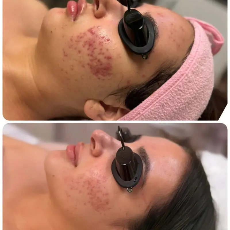 Skin progress during a course of acne treatments at Dawn Esthetics