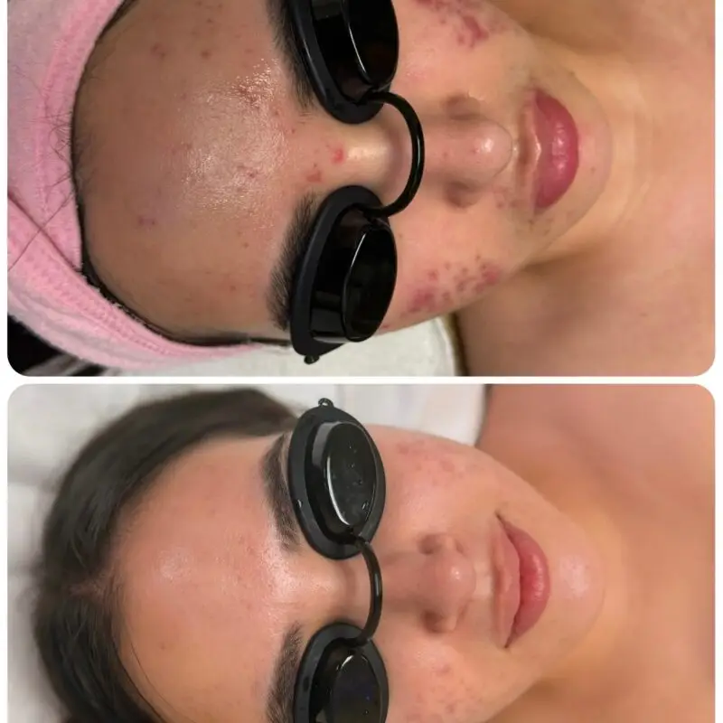 Skin progress during a course of acne treatments at Dawn Esthetics